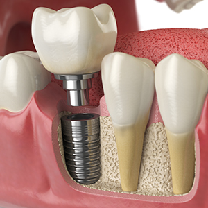 Dental Implants