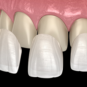 Porcelain Veneers